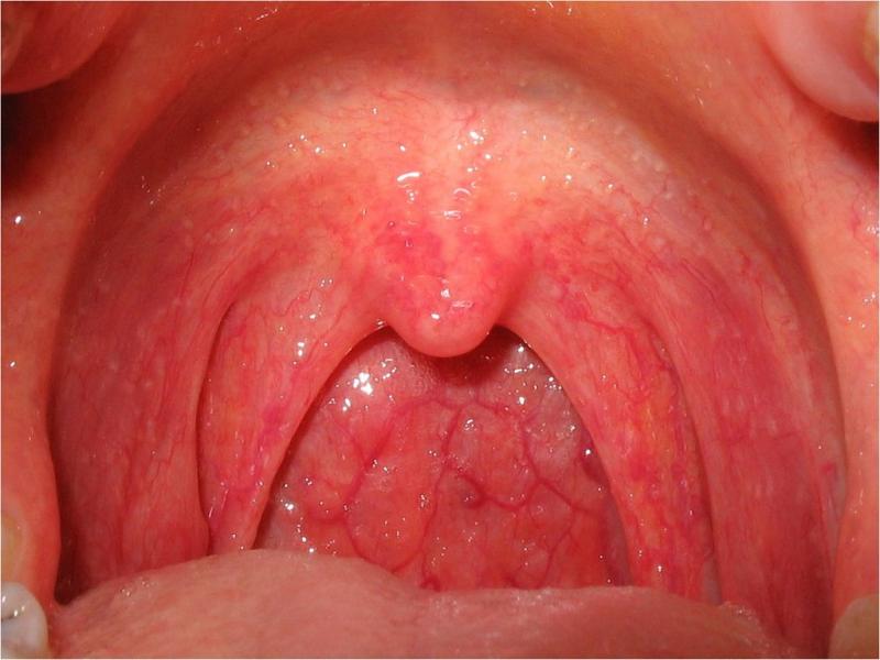 Los sntomas de la faringitis incluyen dolor de garganta, fiebre leve, dificultad para tragar, congestin nasal, tos seca y ganglios inflamados en el cuello.